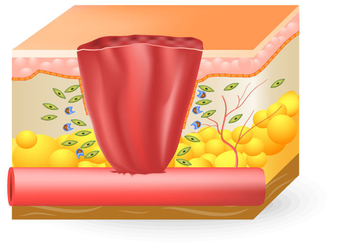 Inflammatory Phase of wound Home Landing Page Health Factor Products 